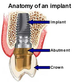 Dental Implants Miami Beach, FL